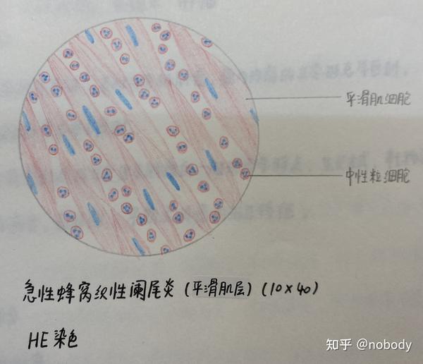 2.急性蜂窝织性阑尾炎(平滑肌层)