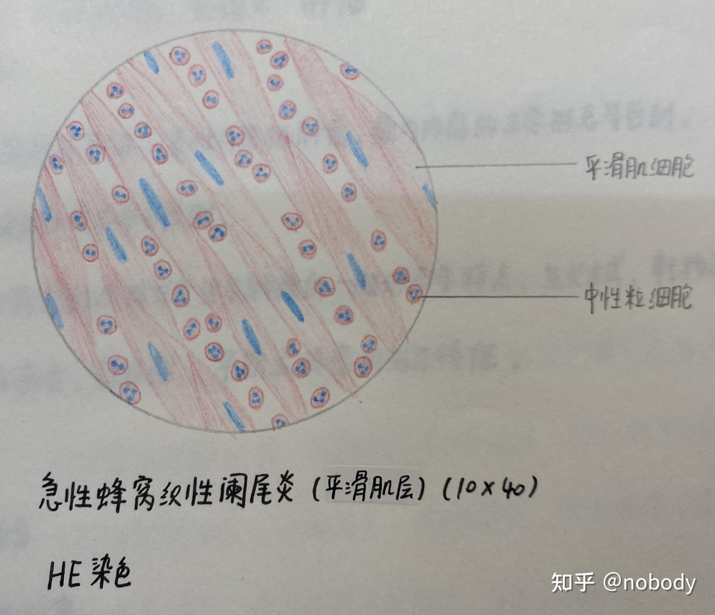 2.急性蜂窝织性阑尾炎(平滑肌层)1.肉芽组织32 人赞同了该文章nobody