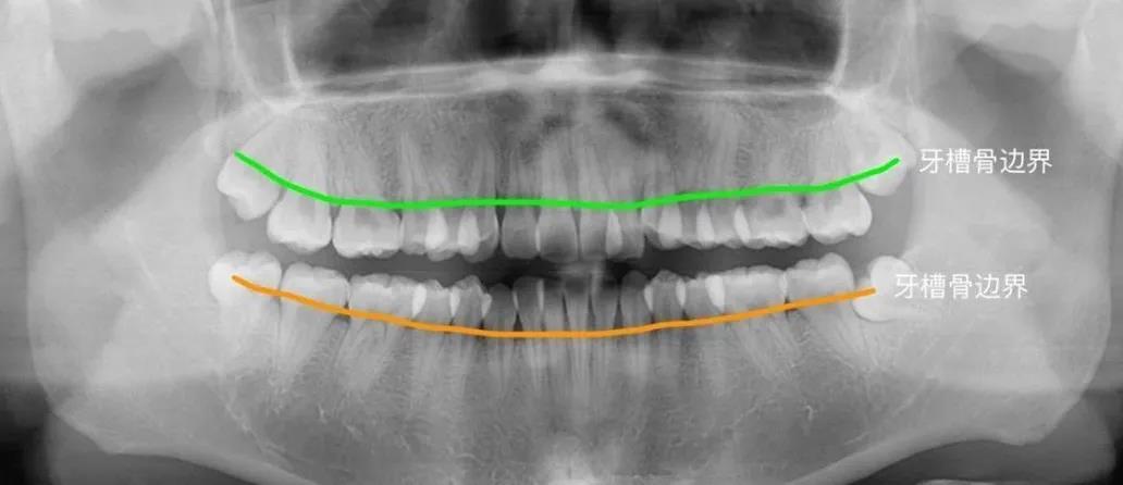 上下牙槽骨的水平线,线以下就是牙根