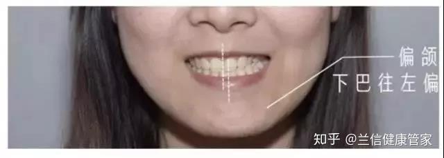 牙齿畸形,凸嘴该如何矫正?