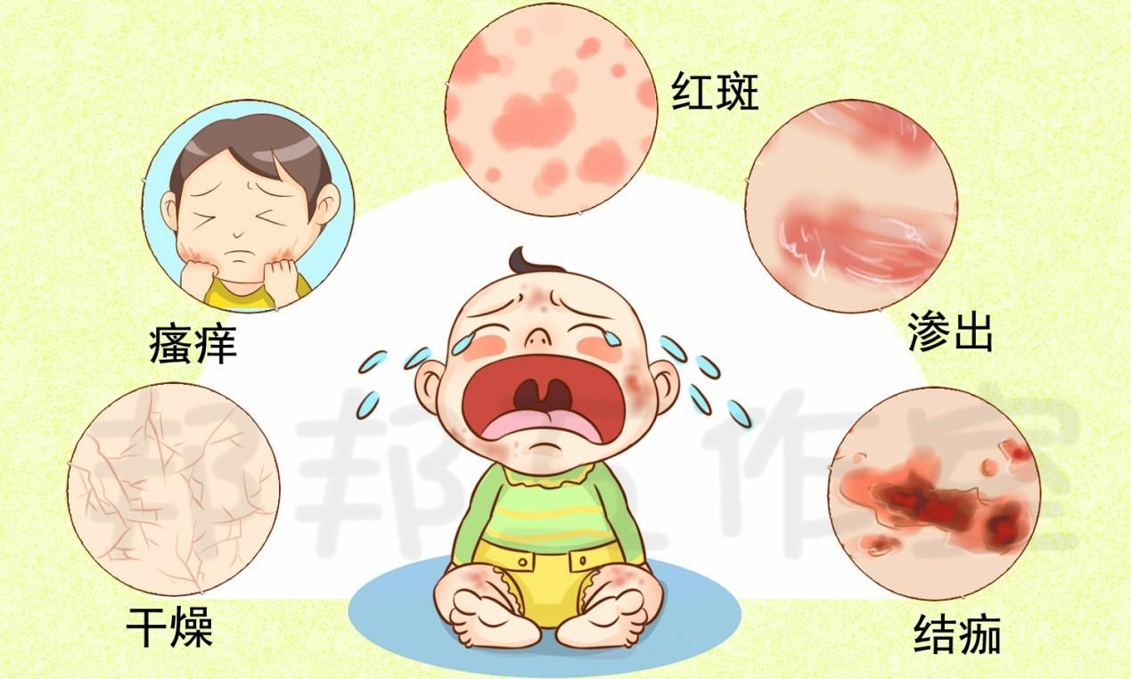 婴儿湿疹常见的六大误区你踩雷了吗