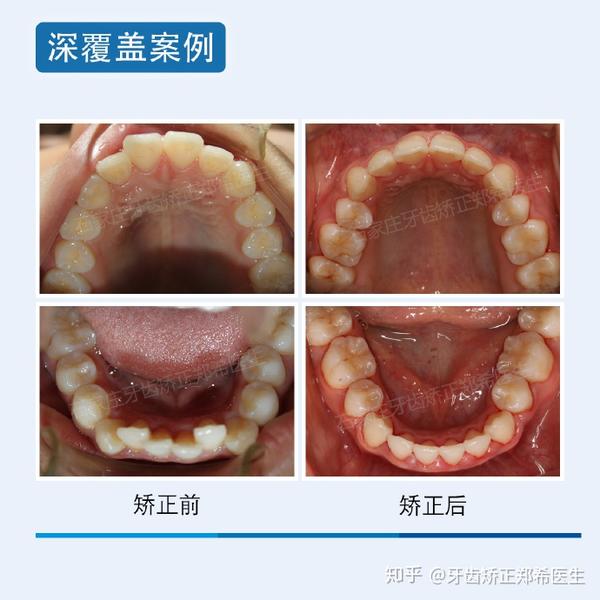 目的是让牙齿内收的间隙有所保障,矫正后牙齿咬合关系和面型都有了