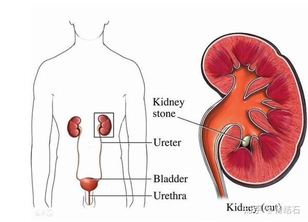肾结石怎么排出