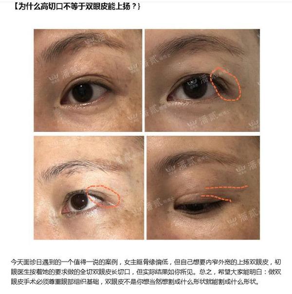 拜托年纪轻轻别再说自己是皮肤松弛了双眼皮手术去皮需谨慎