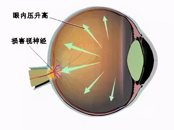 认知青光眼 ▲青光眼视野缺损图示 为什么白内障会引起青光眼?