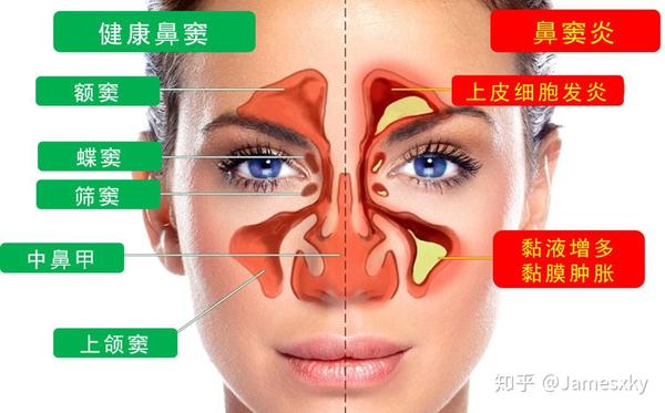 鼻窦炎根据发病的持续时间分为五种.