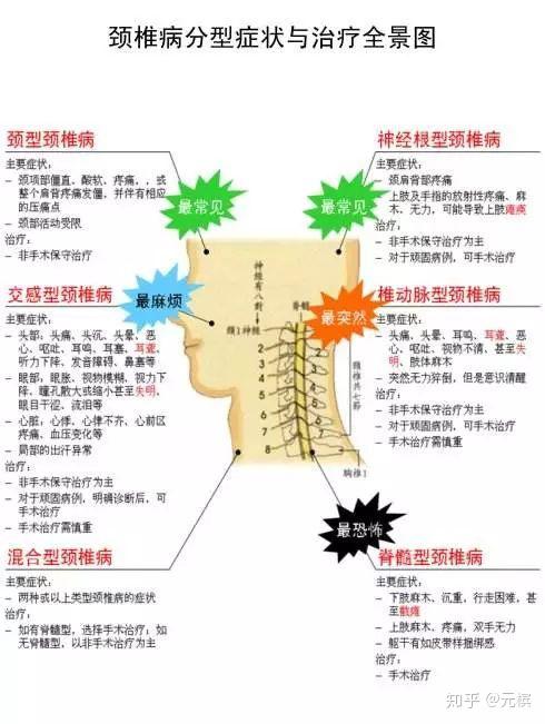 如果同时出现上述几类症状,则考虑为 混合型颈椎病.