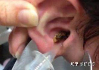 耳垢学名耵聍,是由人类的耵聍腺分泌淡黄色的粘稠物质组成,具有保护