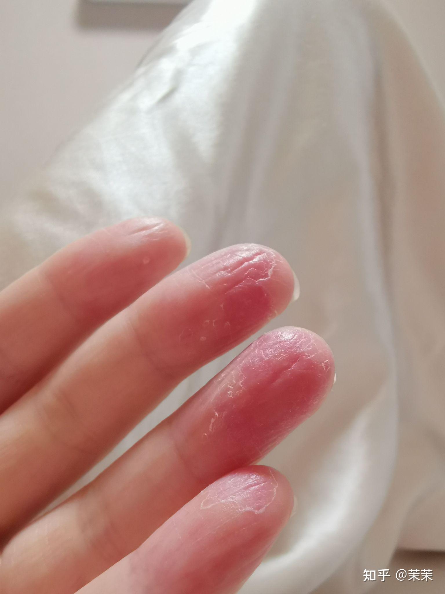 每年56月份手指尖脱皮是什么情况