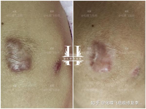 摔伤增生疤痕修复代谢一次,效果显著