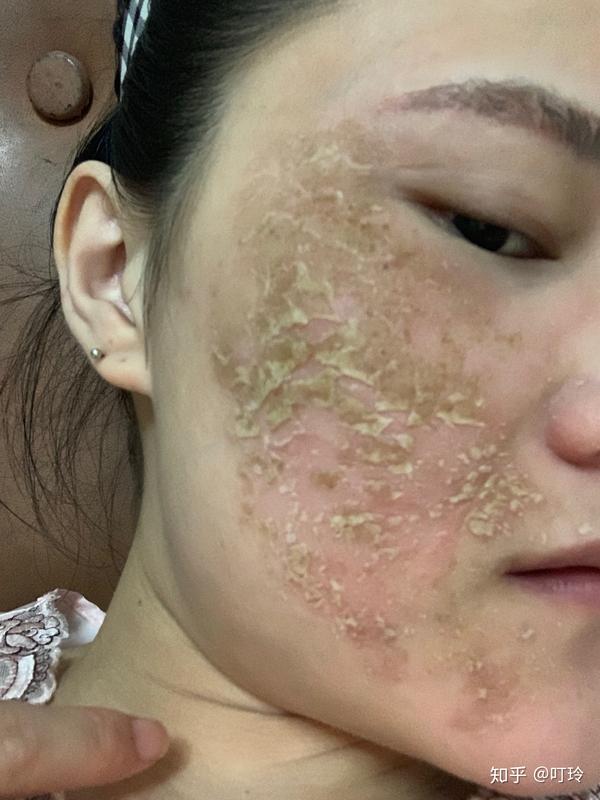激素脸,现在用了中草药结痂了,一路来,折腾太多了,从裸脸,到烧伤膏
