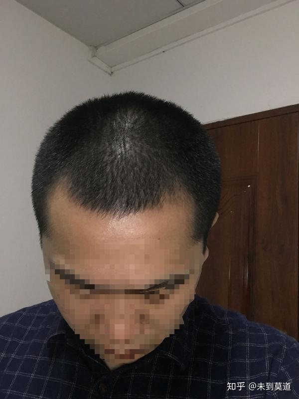 雄性激素脱发m型脱治疗记录贴