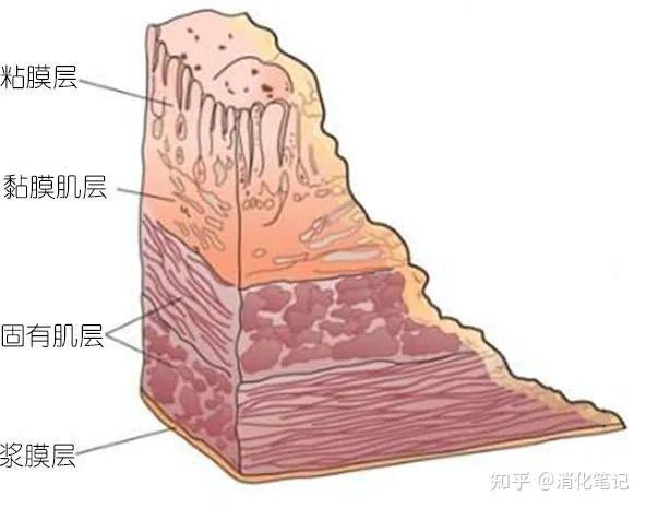 胃层次间质瘤是否处理及如何处理主要依据肿物大小及是否有不良因素.