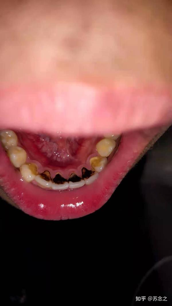 牙齿内侧黑黑的是什么东西