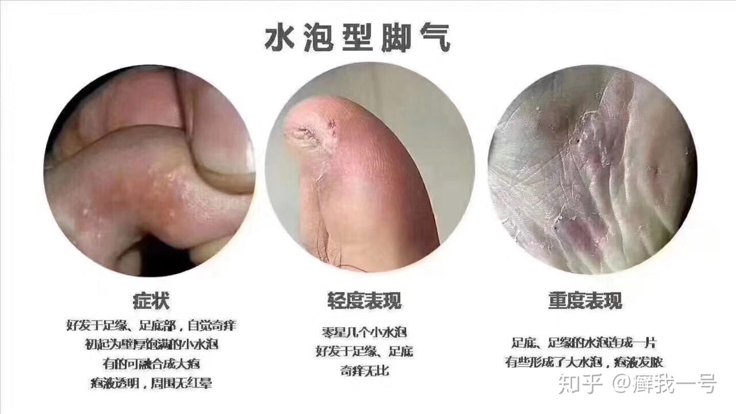 脚气湿疹皮炎