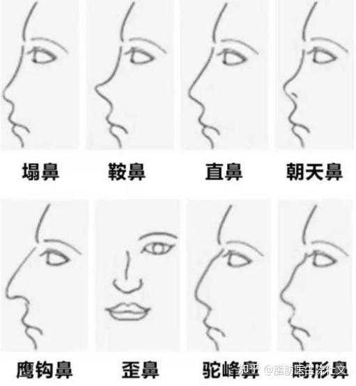 1,鞍鼻:这可是一鼻子畸形中的一种,和低鼻一样,其鼻梁高度低于正常值