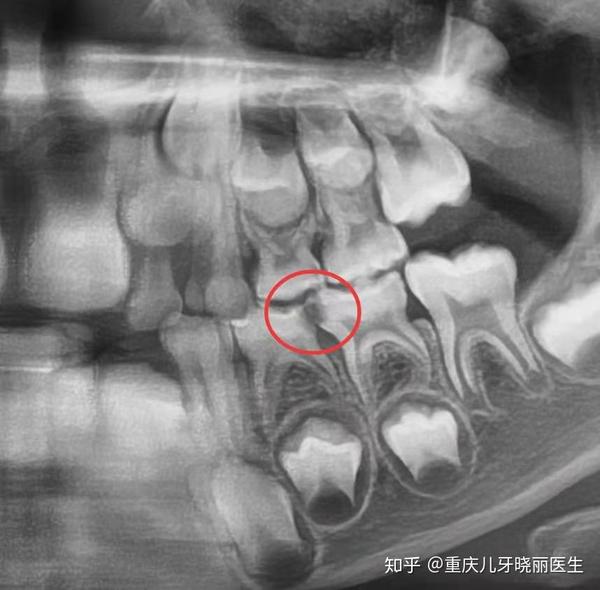 科普看牙为什么要拍片