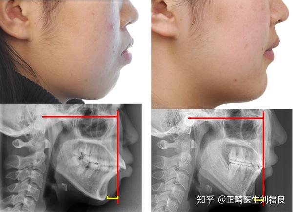 牙齿矫正真的送下巴吗都能达到什么效果