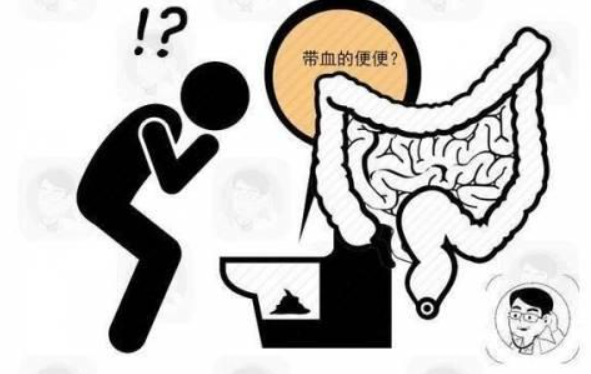 更严重的时候咳嗽,行走等,会致使腹部压力增大的情况也会导致痔核脱出