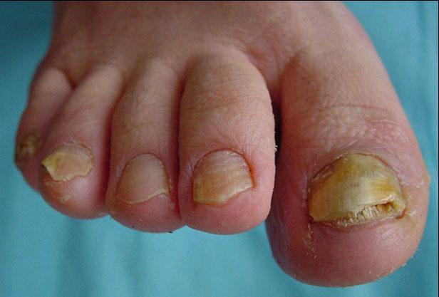 灰指甲也被称作甲藓,是由真菌感染甲板所致,可表现为甲板变软下陷,也
