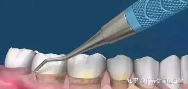 同样都是洗牙,为什么他花200,我花3000