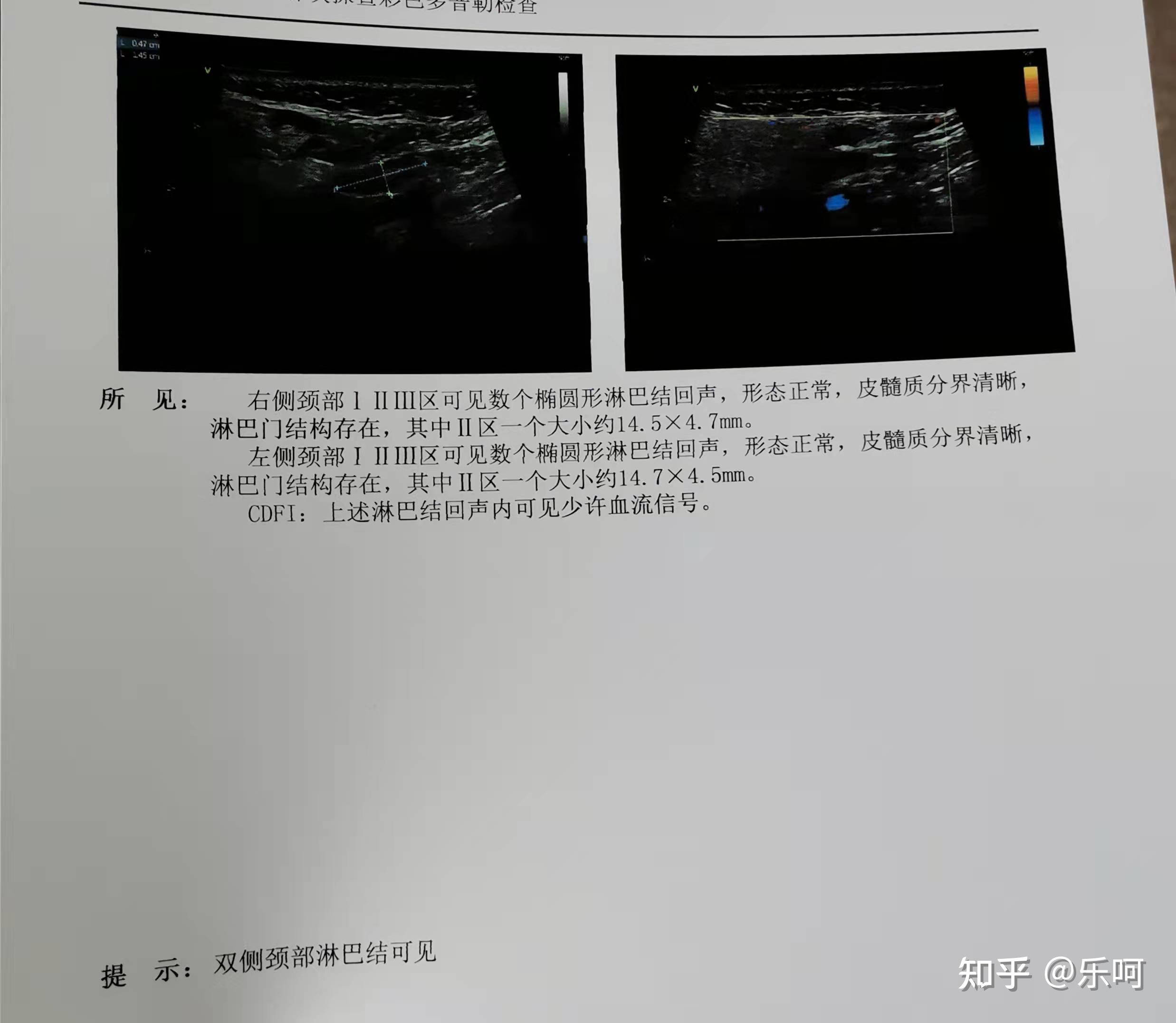 甲状腺癌术后遇到了淋巴门结构消失先别慌