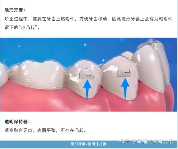 隐形牙套和透明保持器,它们到底有啥区别?