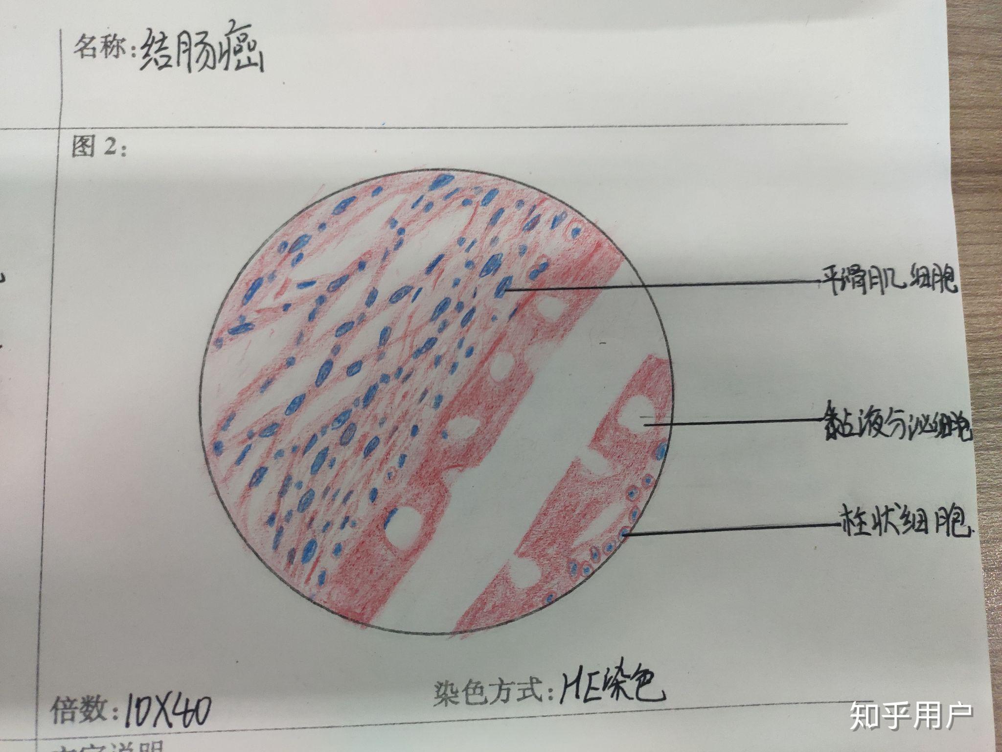 有没有人有病理的结肠腺癌红蓝铅笔手绘图啊