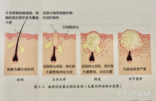 接下来我们再看看不同形态的痤疮过程长什么样子: 1,白头粉刺