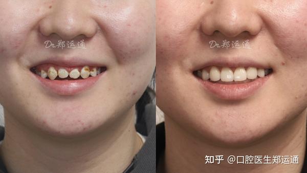 郑州正畸后前牙美学修复,不只是美观,更胜在自然