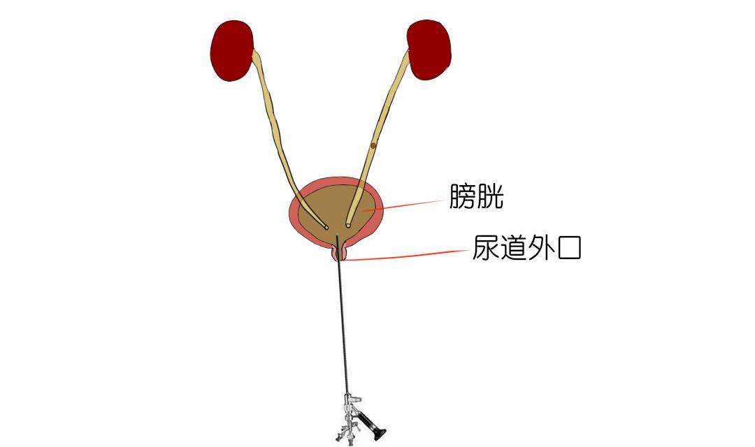 输尿管镜从尿道外口进入,顺着尿道进入膀胱1,首先,我们要先找到结石二