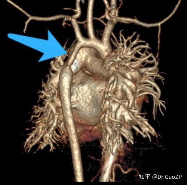 聊聊先天性心脏病——主动脉弓缩窄