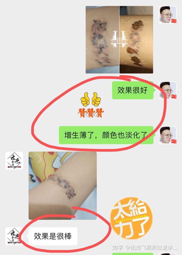 广东梅州洗纹身增生疤痕修复