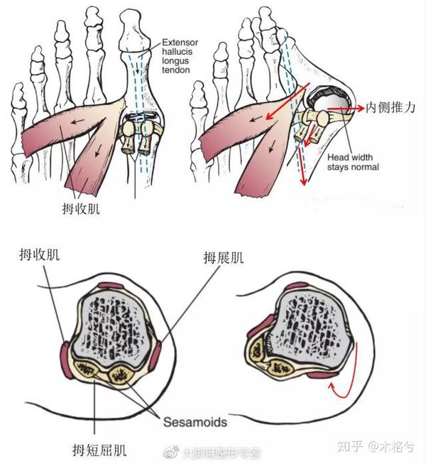 拇外翻的病理解剖学与病理生理学