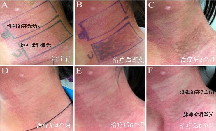 治疗鲜红斑痣海姆泊芬光动力与脉冲染料激光有什么不同