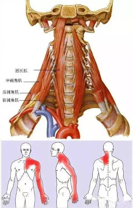 前斜角肌综合征该如何缓解?