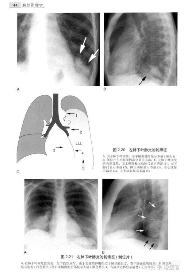 教科书上也很少见这么经典的胸片附肺实变的轮廓征图