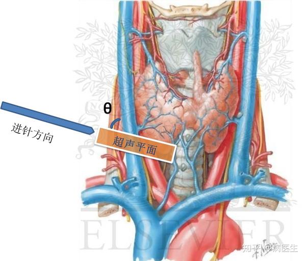 超声显示颈内静脉横切面,可以略呈斜切面,也就是说切面不用十分垂直