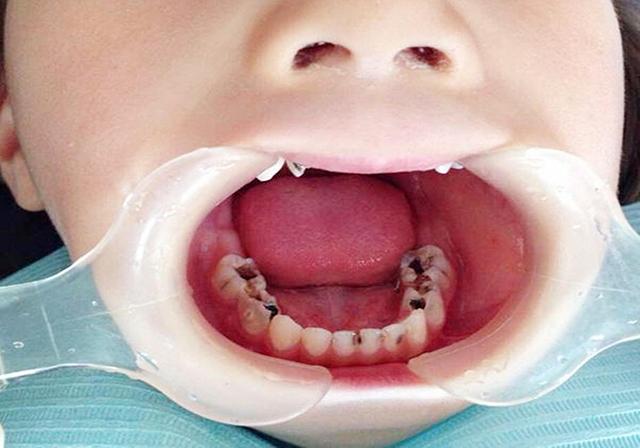 医生看到牙齿之后就痛批她父母: 小时候不让孩子刷牙,大一点又