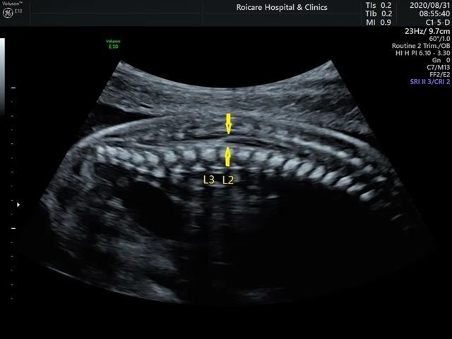 胎儿期发现脊髓圆锥位置低的临床指导