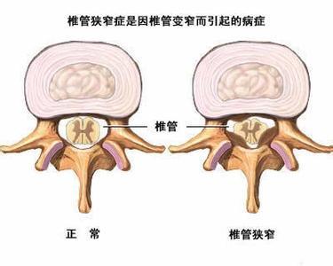 真假李逵——腰椎间盘突出症中的李鬼你遇见几个?