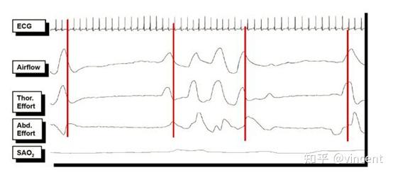 多导联睡眠呼吸监测psg解读