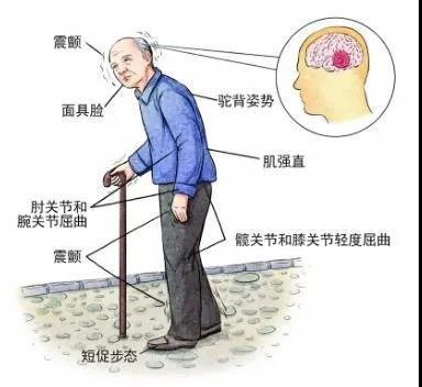 帕金森病康复锻炼至关重要从这几方面入手控制病情有希望