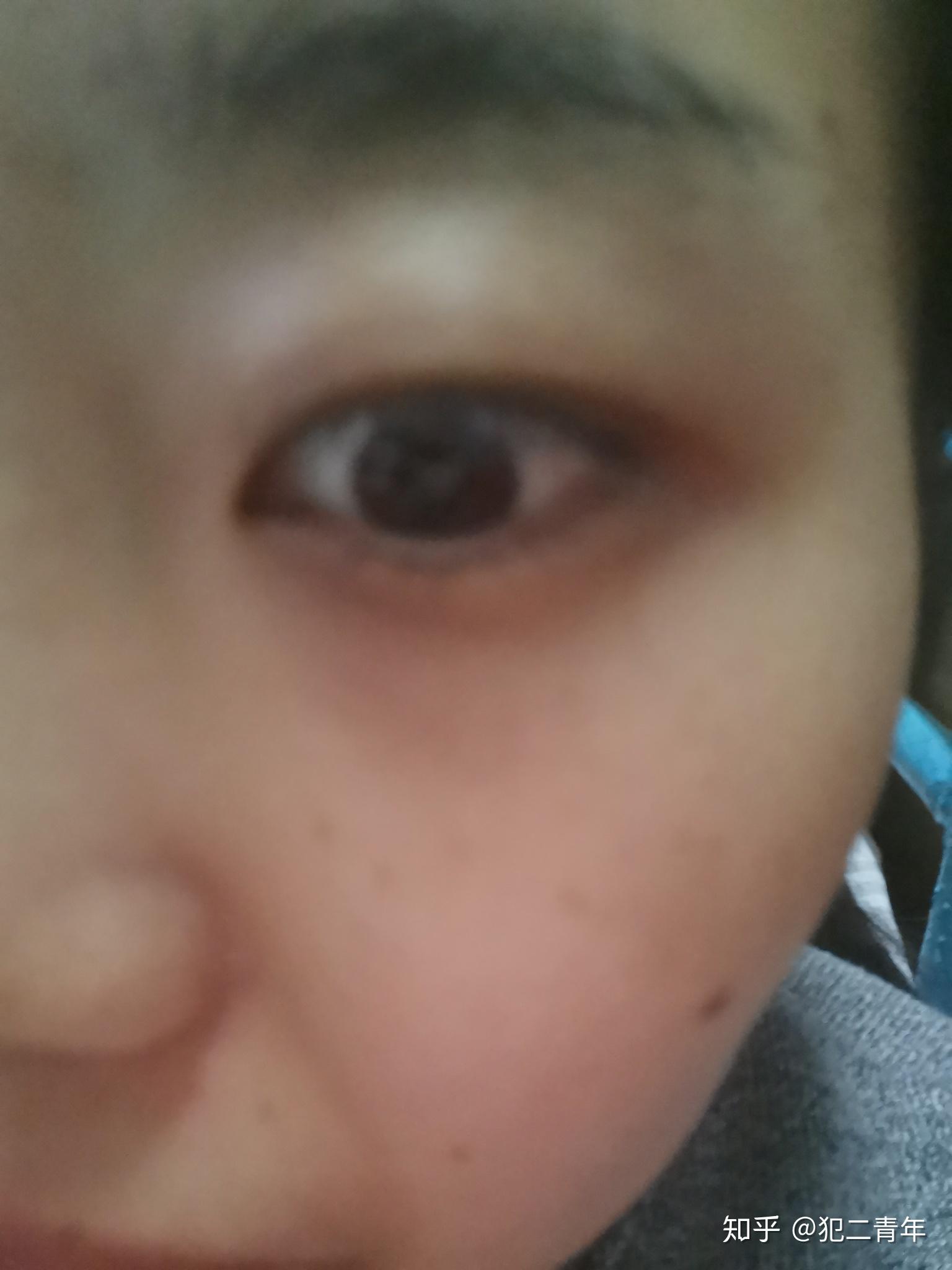 为什么有人的眼睛周围自然发黑像画了烟熏妆