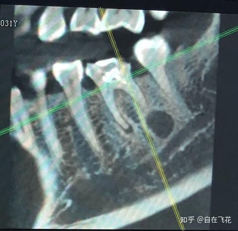 包括2017年在上海拔除智齿时,做 ct 扫描,也还未发现囊肿痕迹.