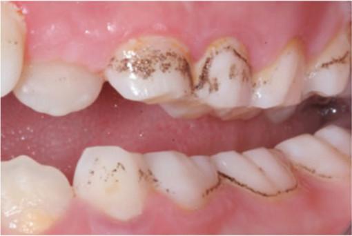 早期的蛀牙有方法补救吗