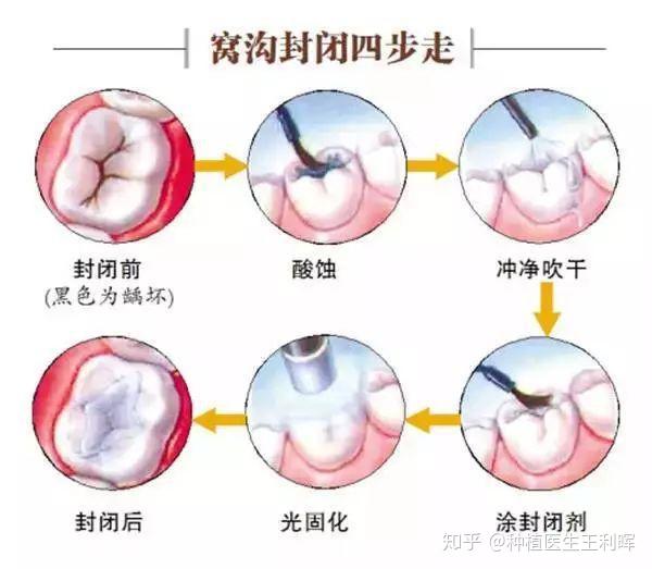 让孩子做窝沟封闭有必要么?听我说说