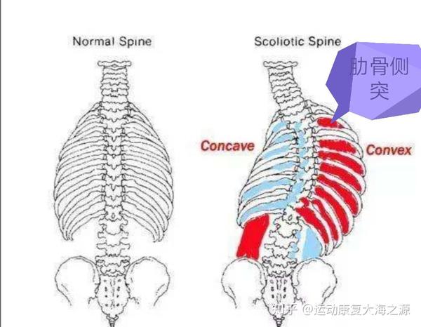 脊柱侧弯导致肋骨侧突导致呼吸困难