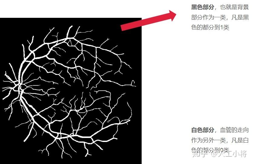 深度医疗4基于深度学习眼底毛细血管分割