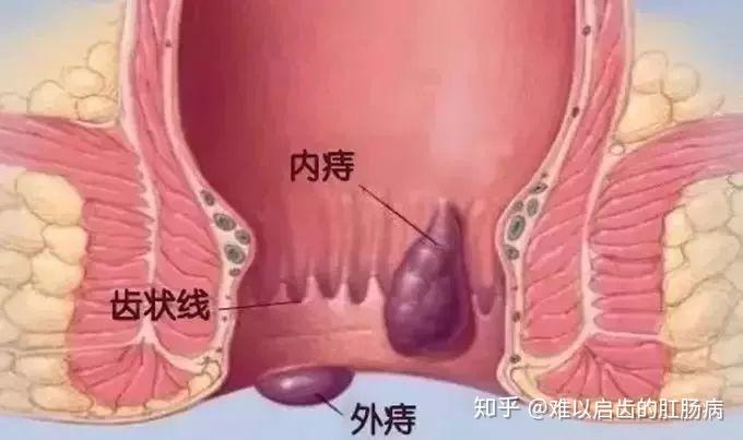 如上图所示,其中混合痔是内痔和相应部位的外痔相融合.